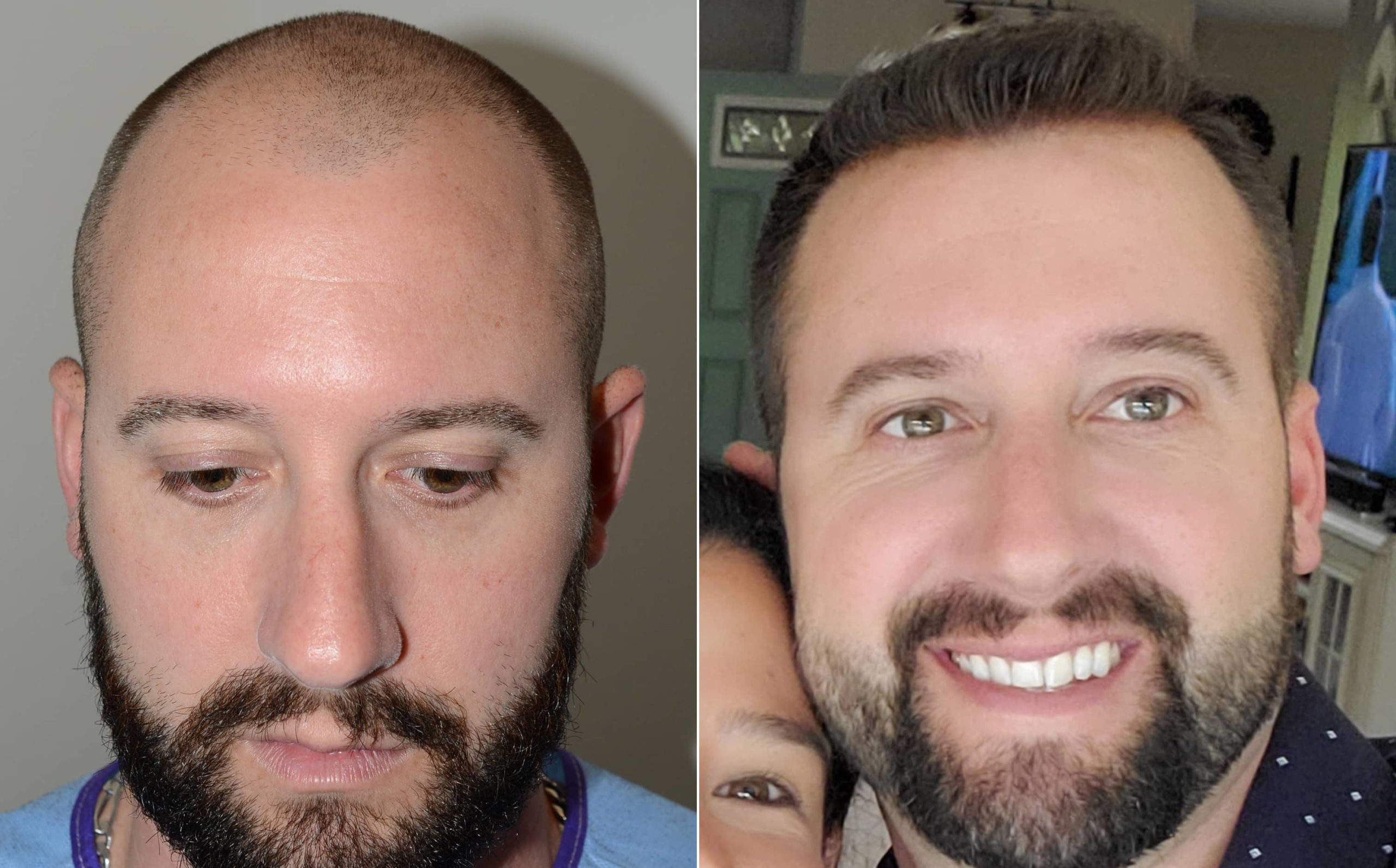 before and after hair transplant