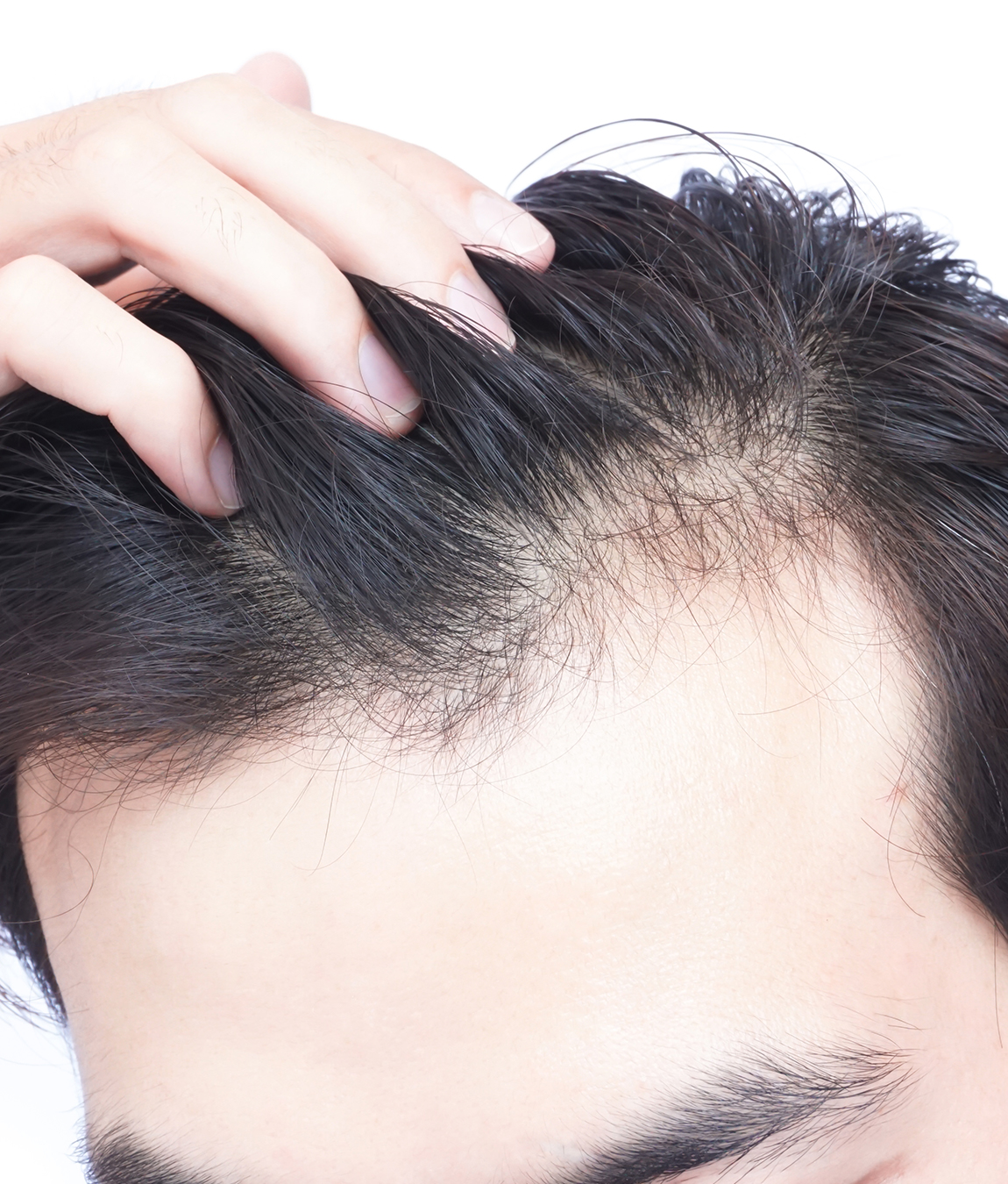 Permanent Solution for Hair Loss